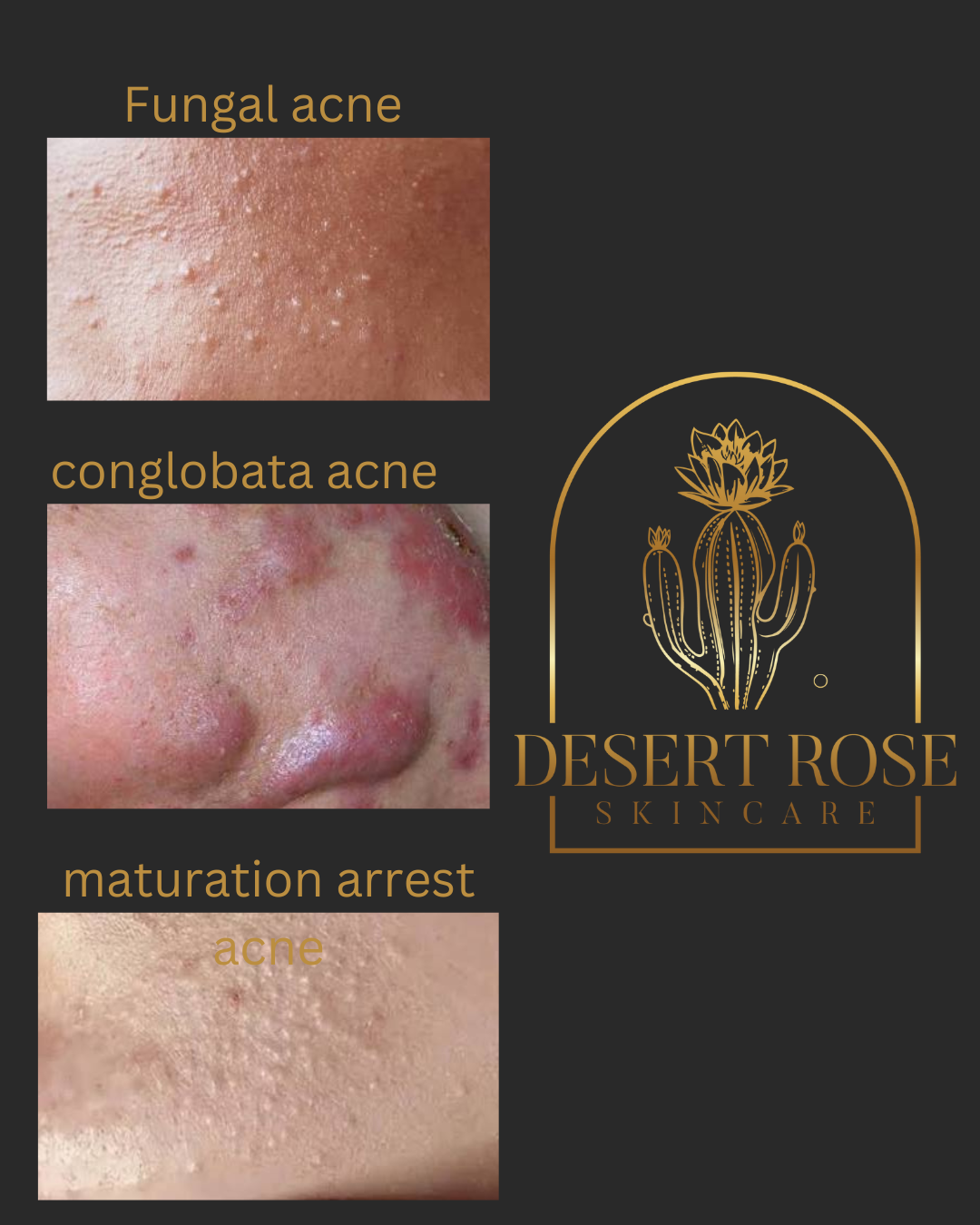 Acne Authority: Elevate Your Practice and Become the Go-To Specialist