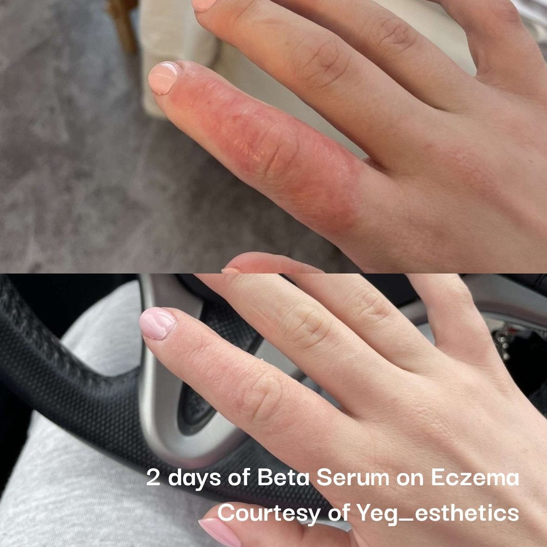 Neogenesis Beta-Glucan
Serum