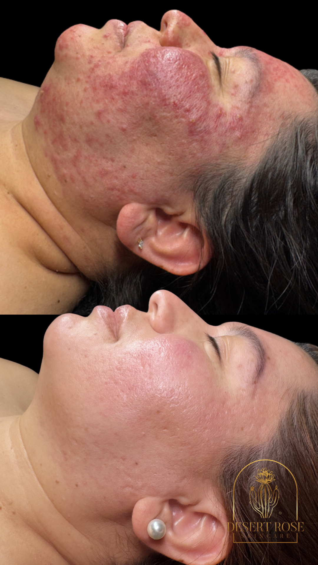 Comprehensive Client Case Study and Treatment Plan Severe ACNE/ROSACEA