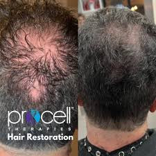 Procell for hair growth package