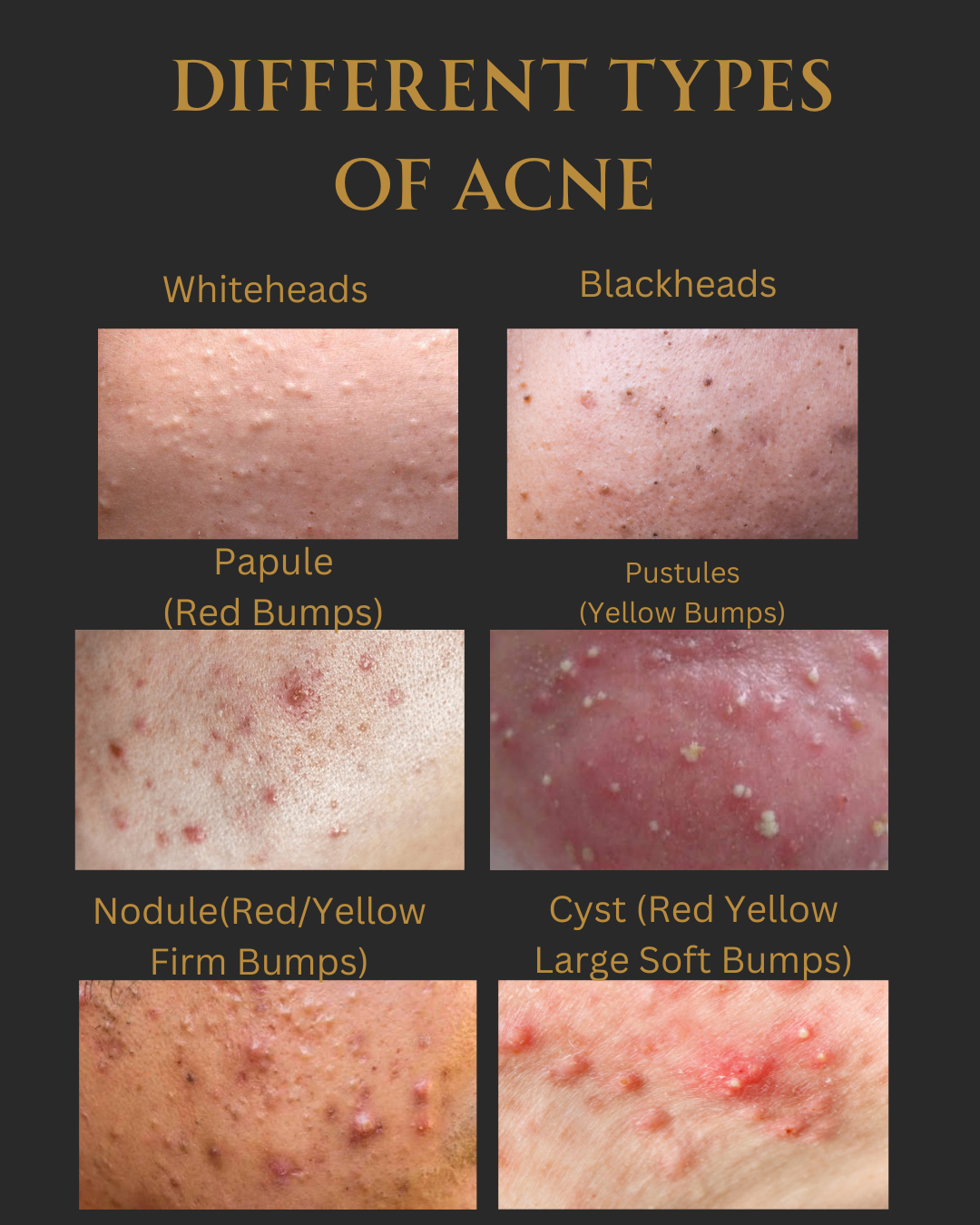 Acne Authority: Elevate Your Practice and Become the Go-To Specialist