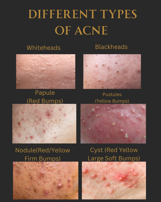 Acne Authority: Elevate Your Practice and Become the Go-To Specialist